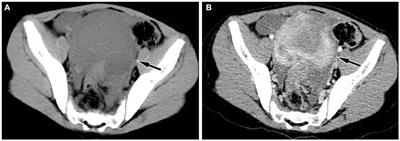 Imaging findings of inflammatory myofibroblastic tumor of sigmoid colon: literature review and case report